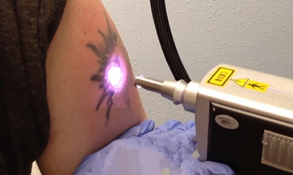 Лазерное осветление татуировки — страшно ли это? Ответ мастеров tattookiev.org